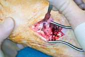 Ankle surgery