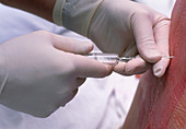 Doctor administering an epidural anaesthetic