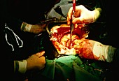 Surgery to replace damaged mitral heart valve