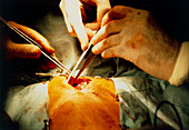 Hole-in-the-heart corrective surgery