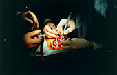 Paediatric heart transplant: close-up of heart