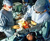 Triple bypass surgery on heart