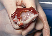 Dissected aortic valve from donor human heart