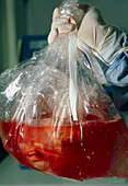 Donated human heart packaged for transpla