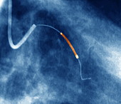 Coronary angioplasty,X-ray