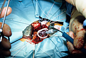 Artificial heart valve surgery
