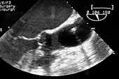 Heart valve surgery,ultrasound scan