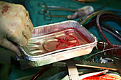 Heart bypass surgery
