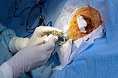 Heart pacemaker surgery