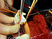 Heart valve operation