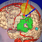 3-D MRI scan of brain tumour for virtual surgery