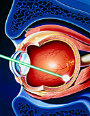 Artwork of laser surgery on detached retina