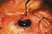 Eye surgery