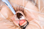Chalazion cyst eyelid surgery