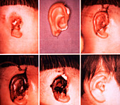 Ear reattachment