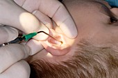 Implanting an ear grommet