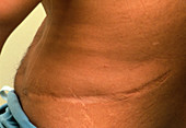 Scar caused by kidney surgery