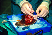 Surgeon preparing donor kidney