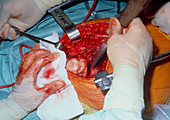 Surgical bone harvesting from femur (thigh-bone)