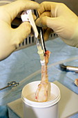Washing a dissected knee tendon