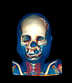 Facial reconstruction,CT scan