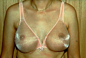 Appearance of woman's chest after reconstruction