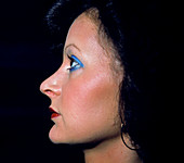 Profile of woman's face after cosmetic surgery