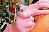 Hands of tattoo artist at work on patient's skin