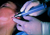 Surgeon conducting liposuction on patient's cheek