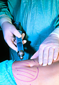 Surgeon performs liposuction on patient's abdomen