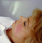 Cosmetic laser surgery