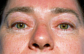 Cosmetic eyelid surgery patient