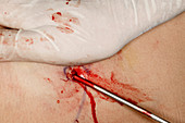 Liposuction surgery