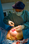 Cosmetic breast and abdominal surgery