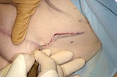 Breast implant surgery