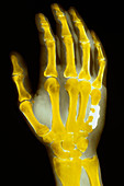 False-colour x-ray of human hand