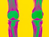 Coloured X-ray of prosthetic knee joints