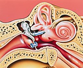 Artwork of prosthetic stapes in middle ear
