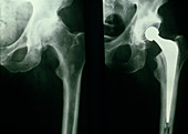 X-rays before & after hip replacement surgery