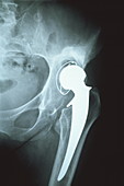 X-ray showing a loosened hip joint prosthesis