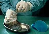 Gloved hands pulling silicone from breast implant