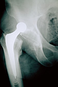 Dislocated hip replacement