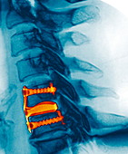 Spinal disc graft, X-ray