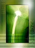 Hip replacement,X-ray