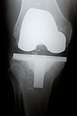 Knee replacement for osteoarthritis