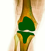 Knee joint prosthesis,X-ray