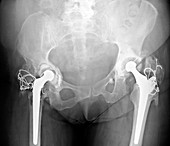 Failed total hip replacement,X-ray