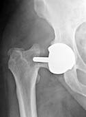 Failed hip resurfacing,X-ray