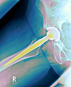 Total hip replacement,X-ray