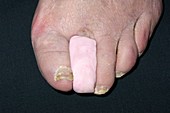 Toe prosthesis following amputation